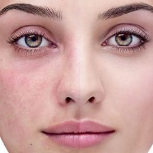 rosacea