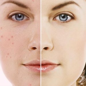 acne-acambg